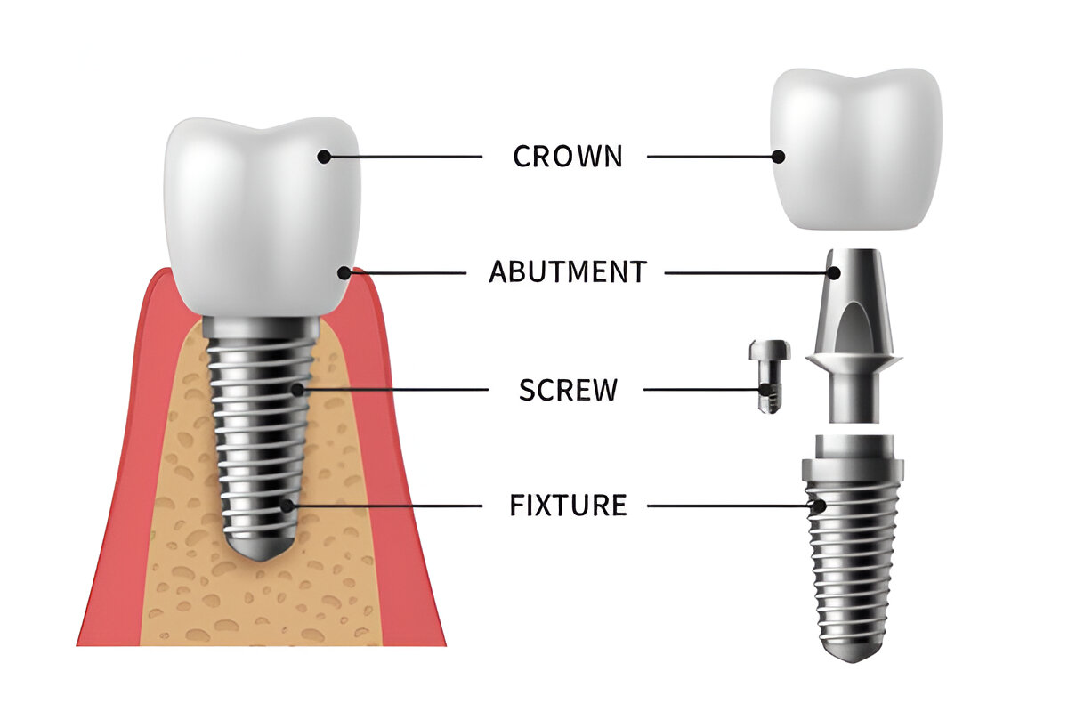 Tooth replacement