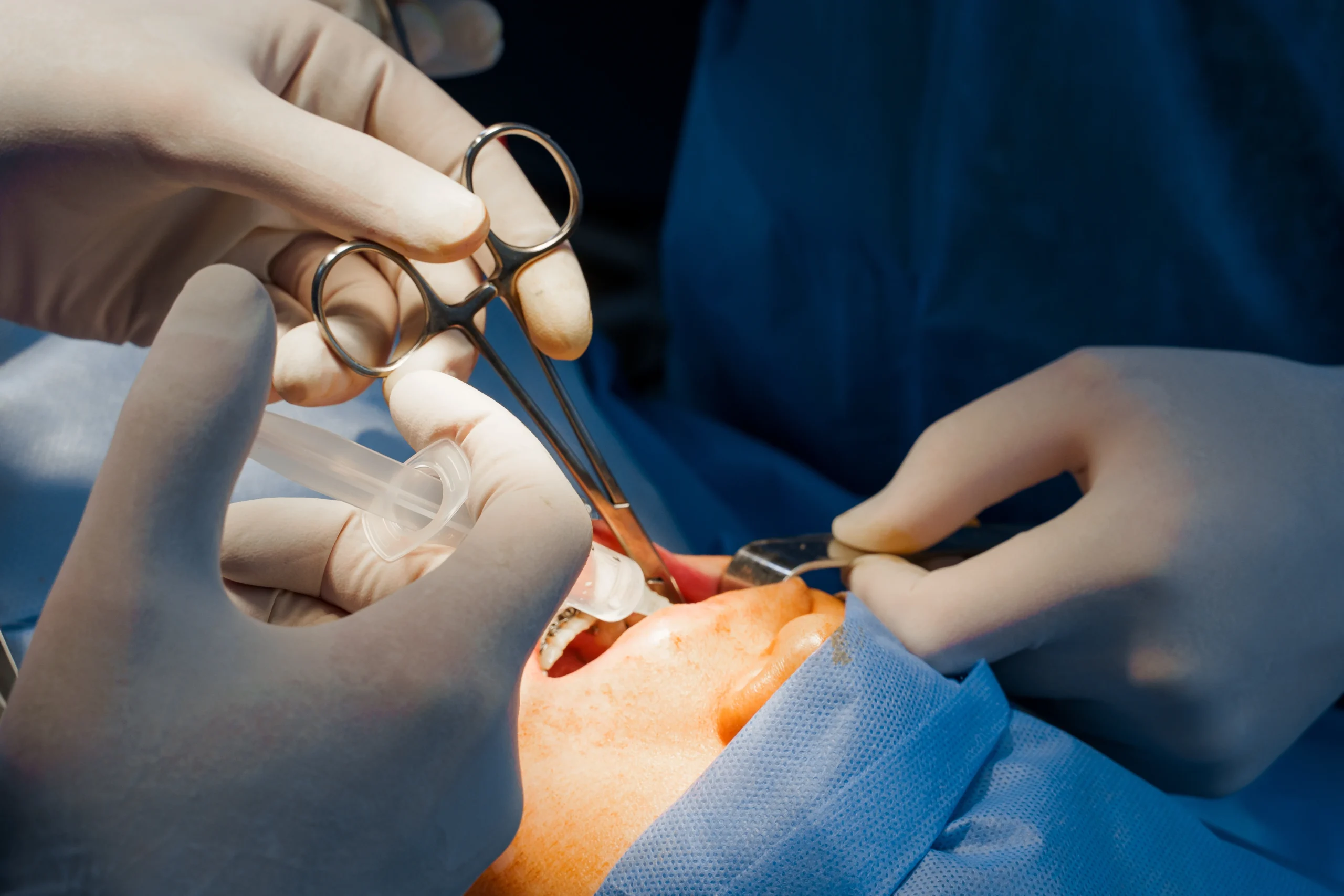 Wisdom tooth removal F-10