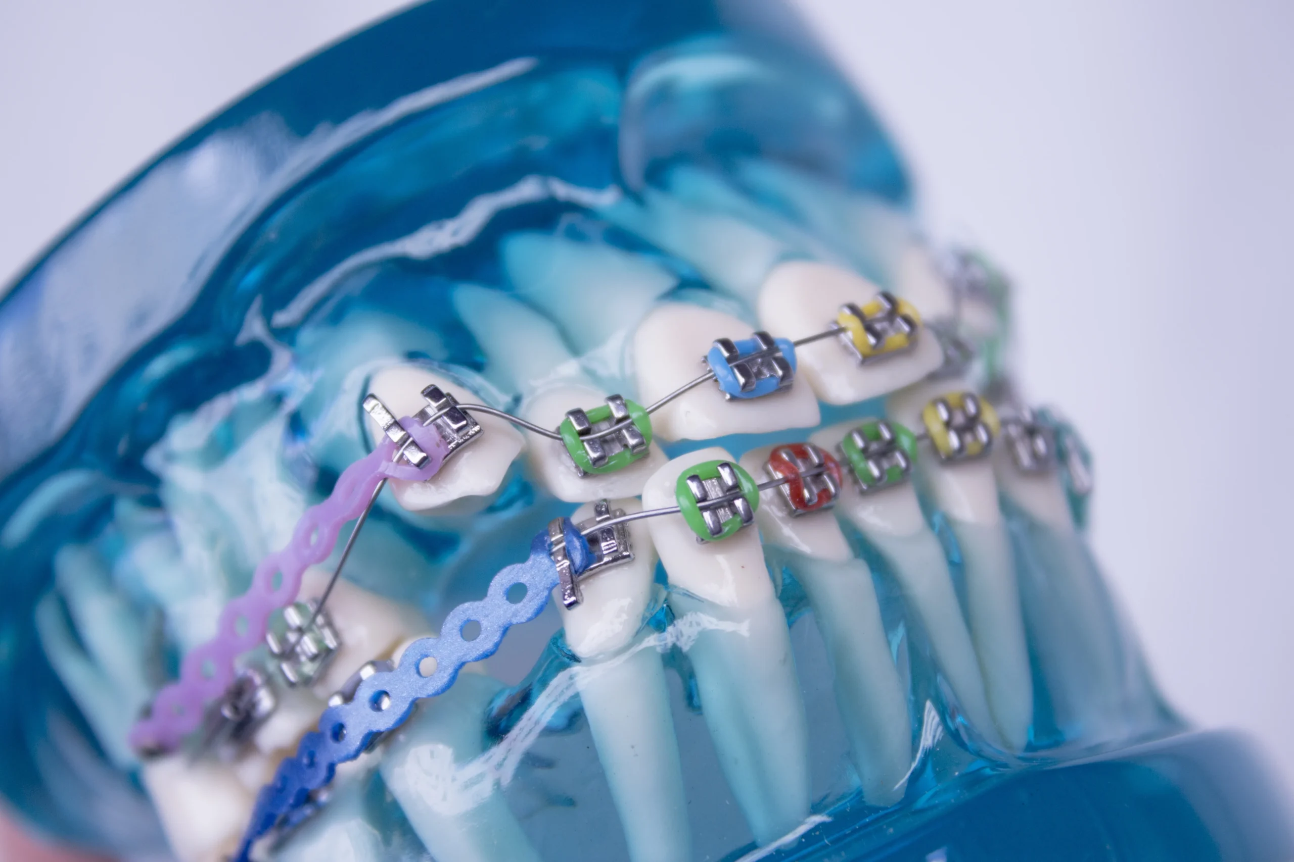 Braces Adjustment