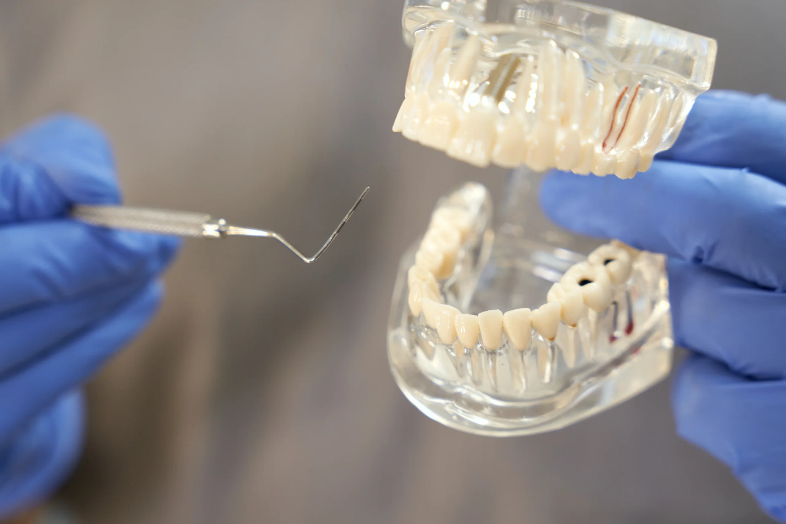 Customized full mouth reconstruction