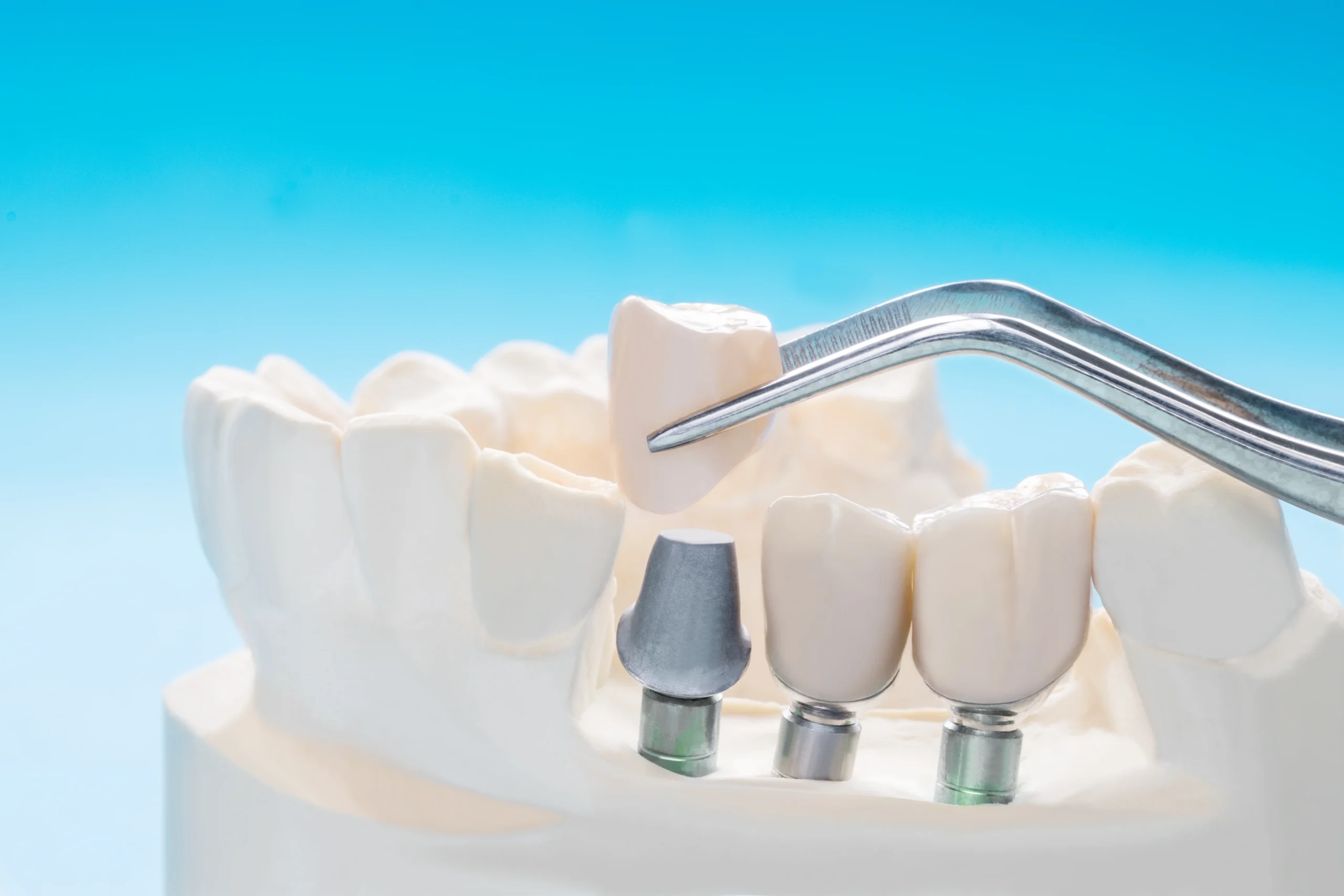 Dental crowns f10 dental clinic