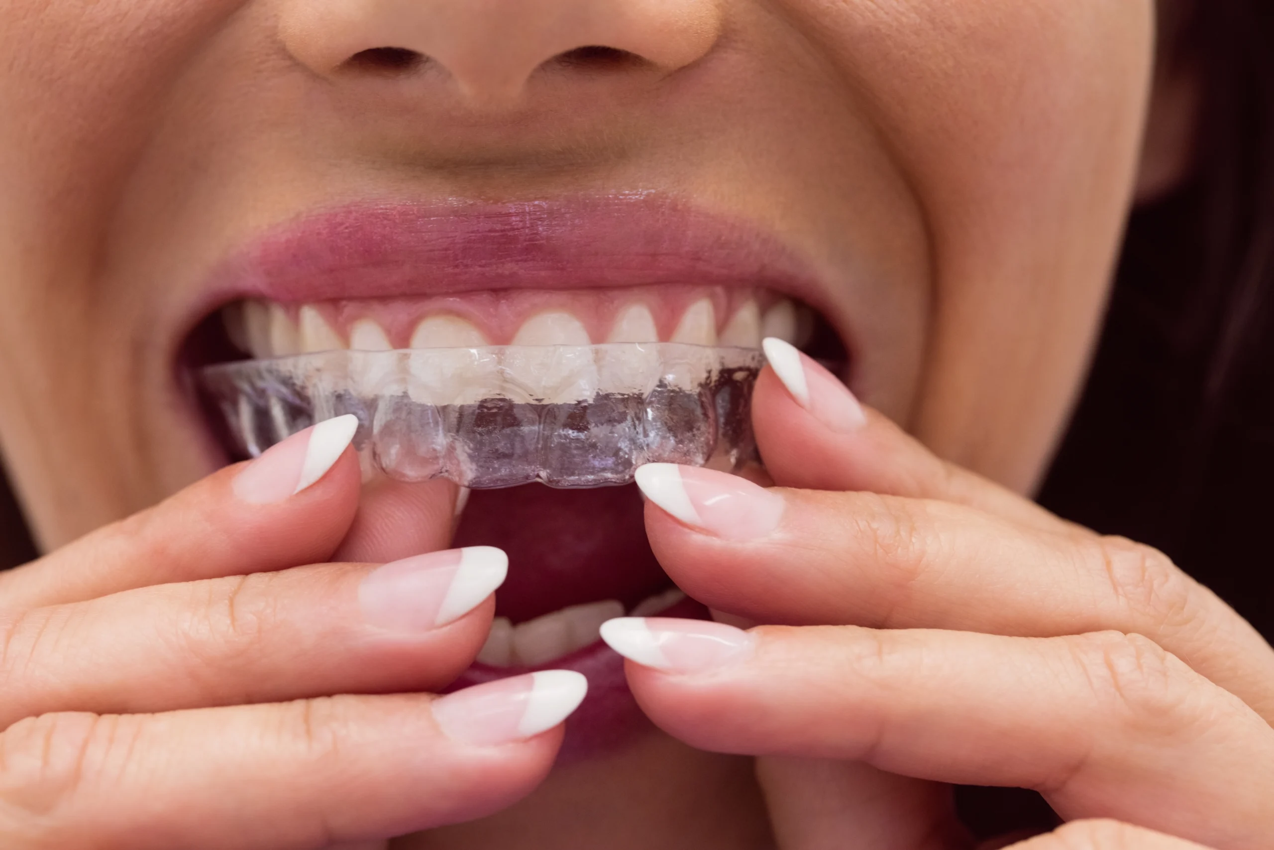 Custom porcelain veneers at Innovative Dentistree in Islamabad
