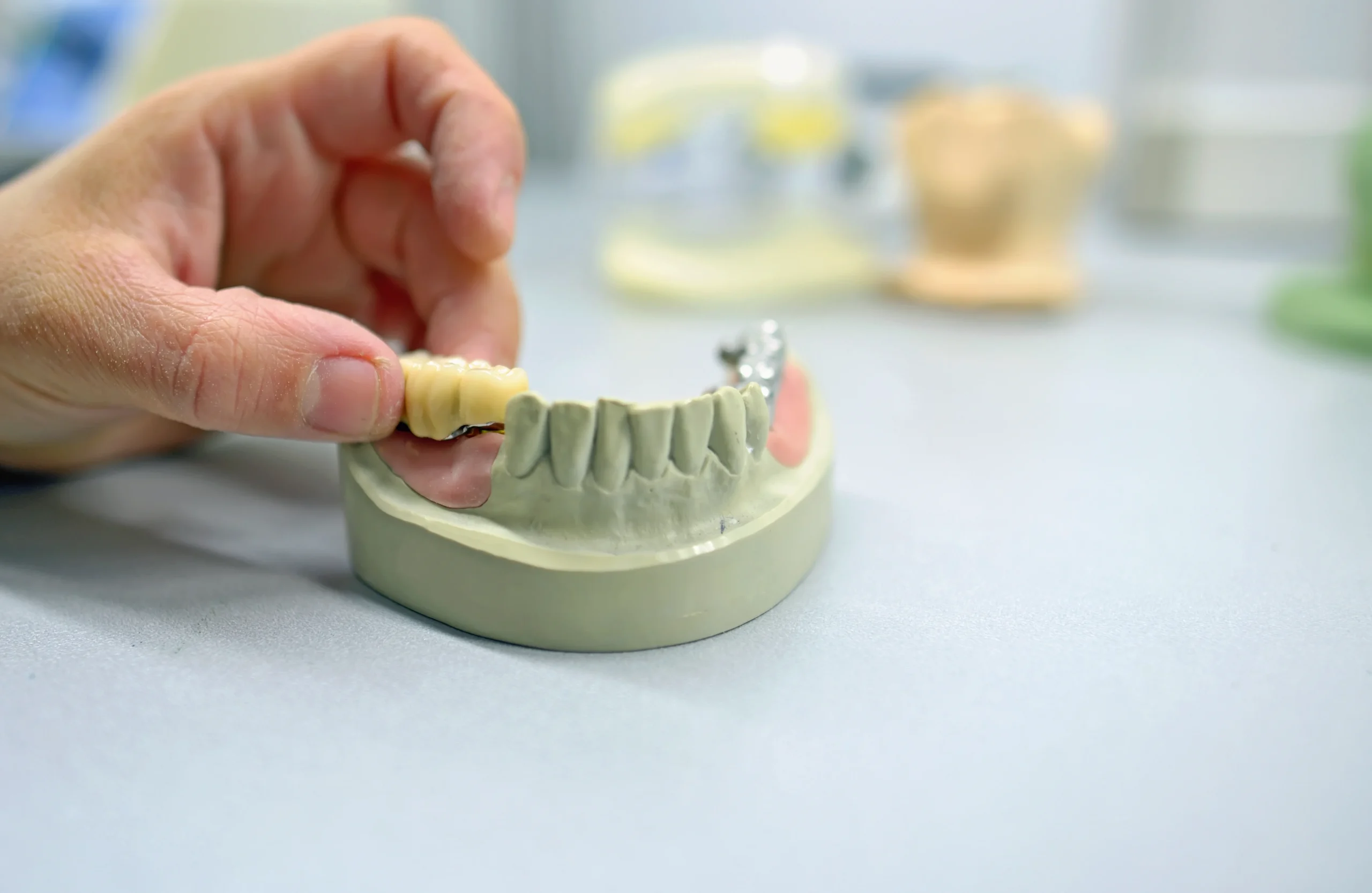 Cracked tooth needing porcelain crown in Islamabad