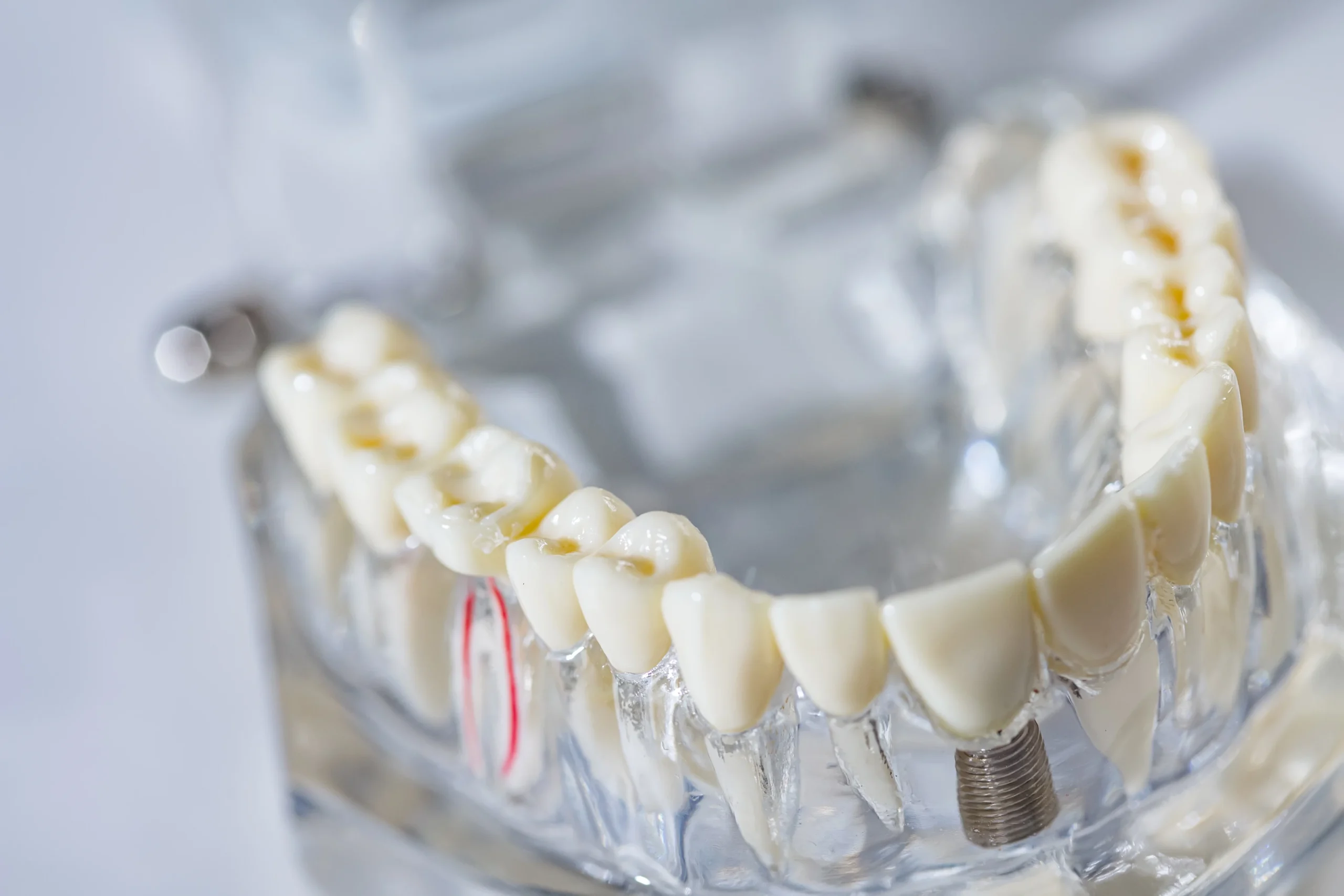 Tooth decay