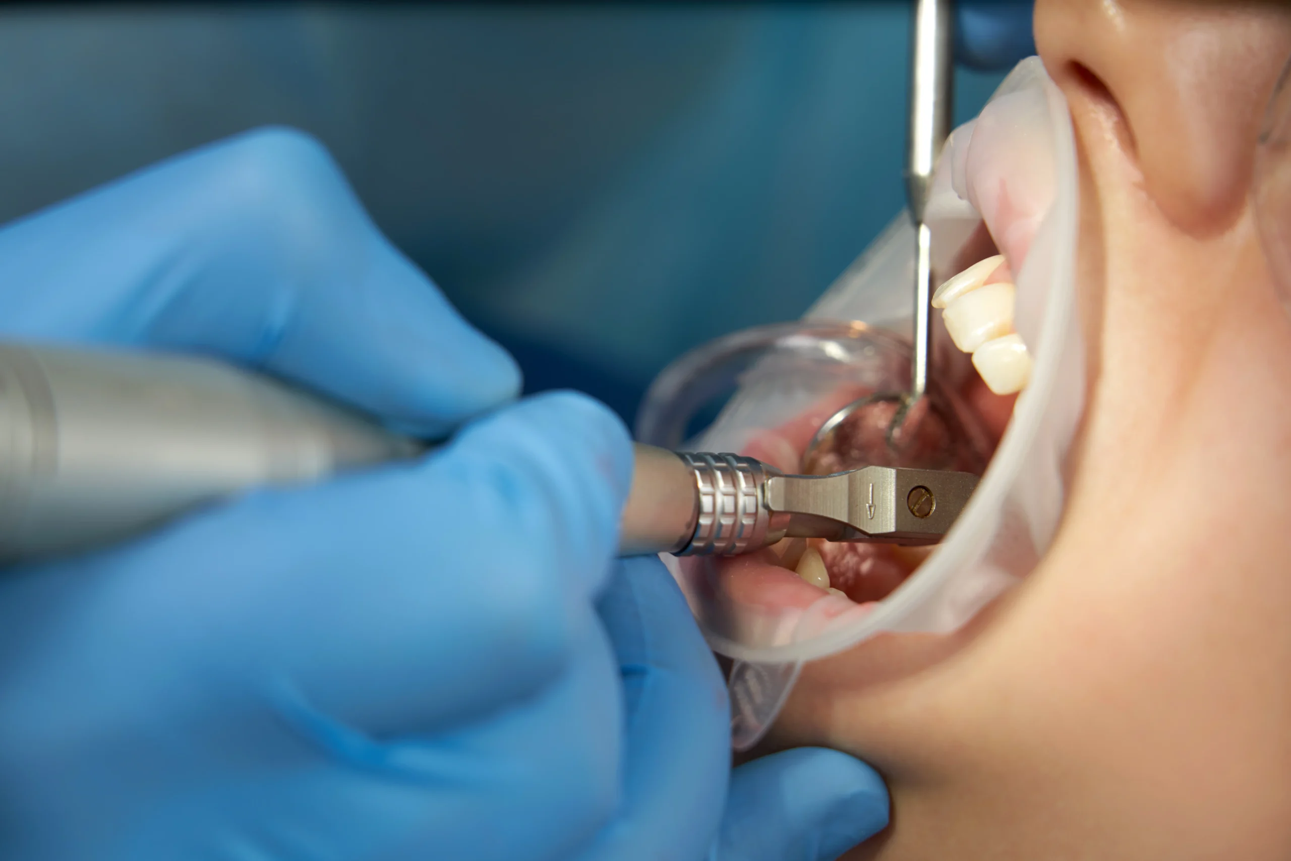 Teeth whitening
