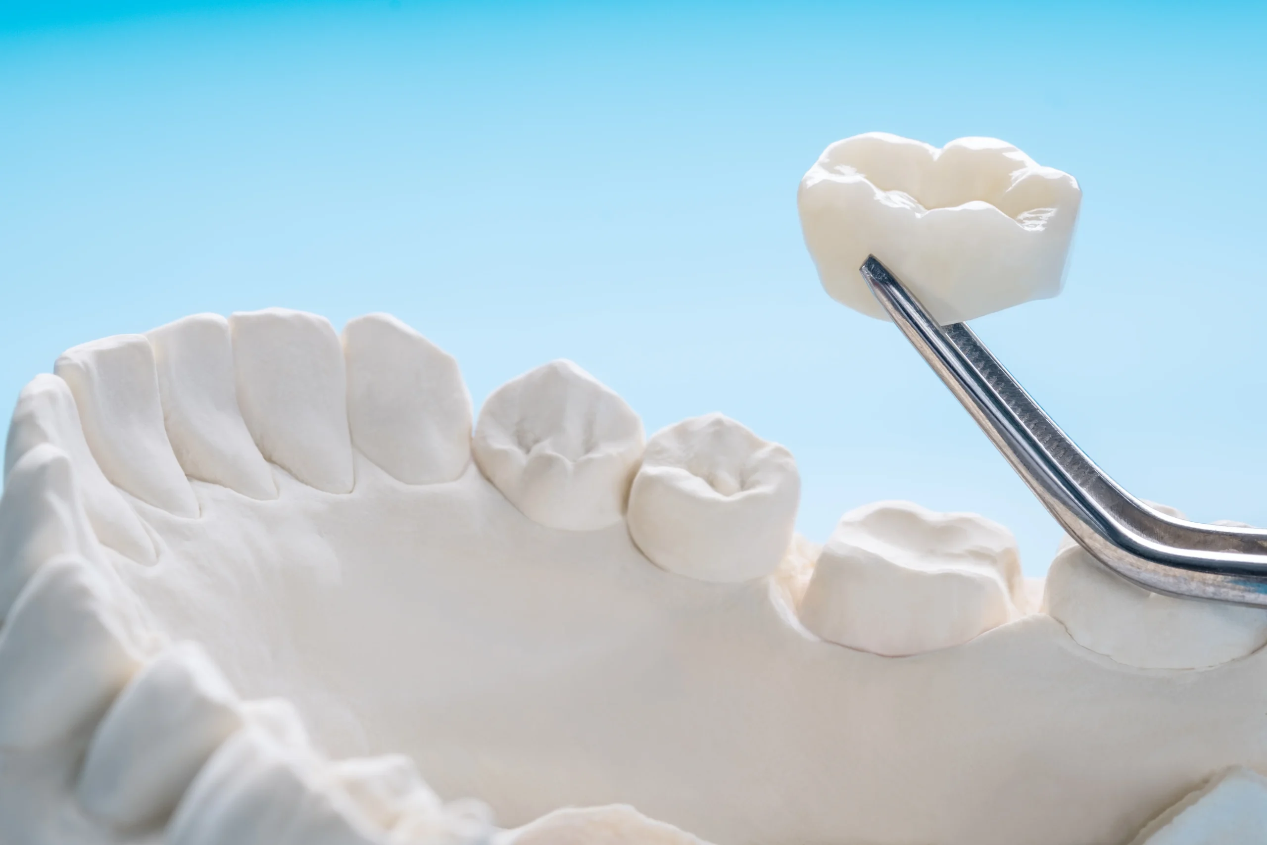 Caring for porcelain crowns – Islamabad clinic