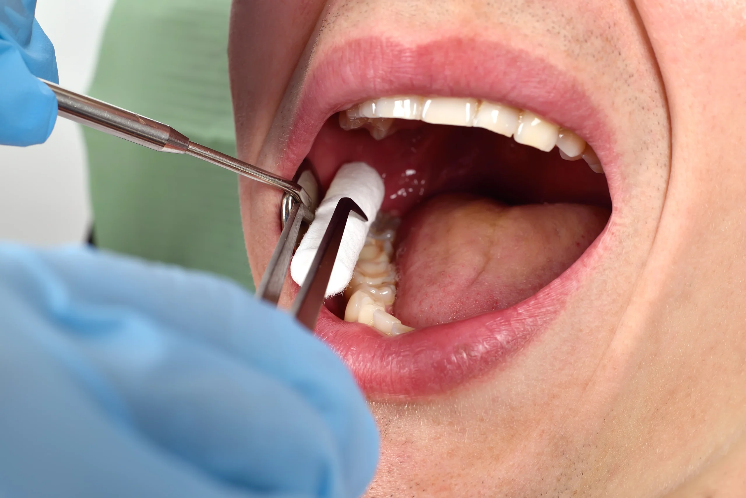 Safe and Durable Dental Fillings for Cavities