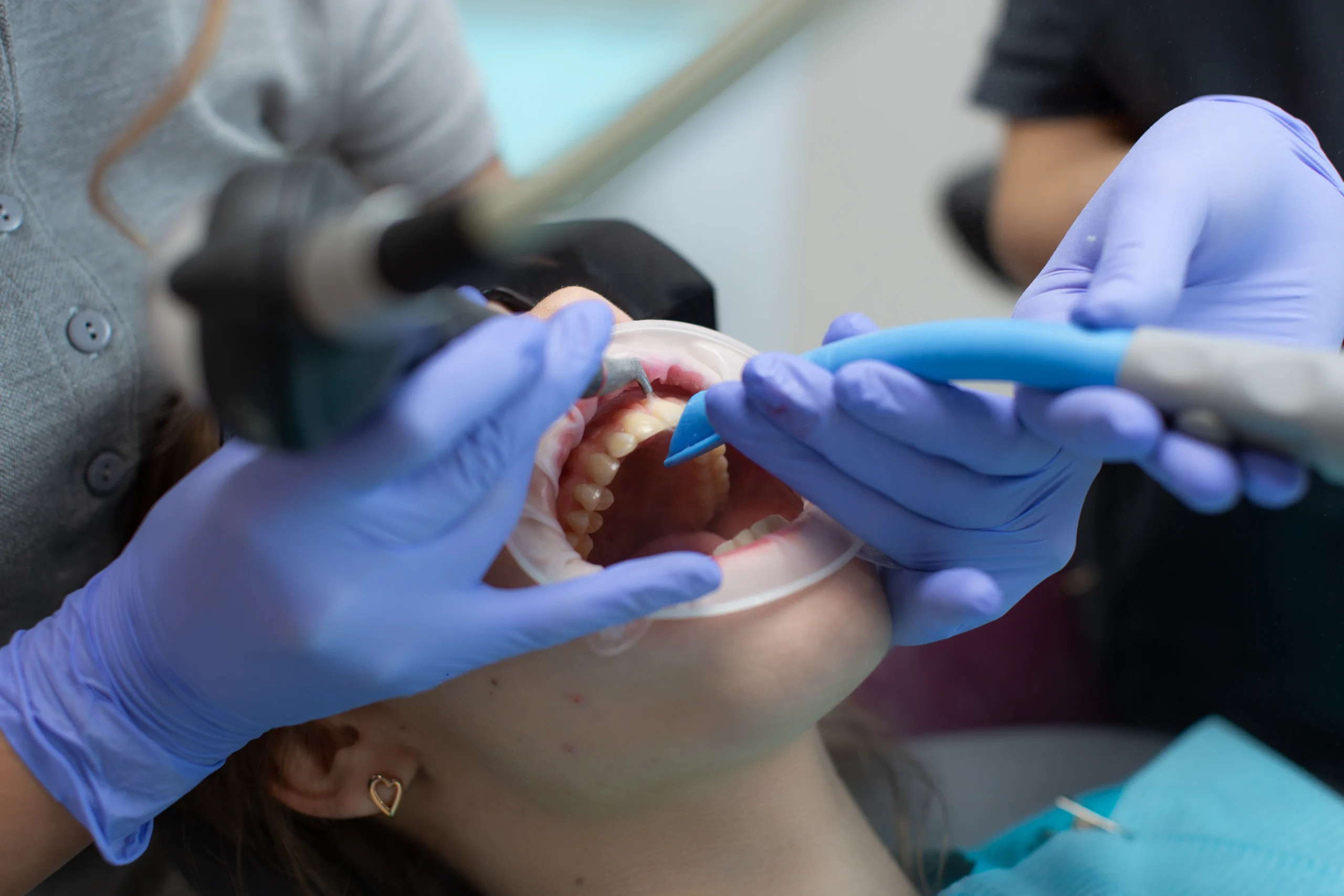 Professional fluoride treatments f10 Clinic
