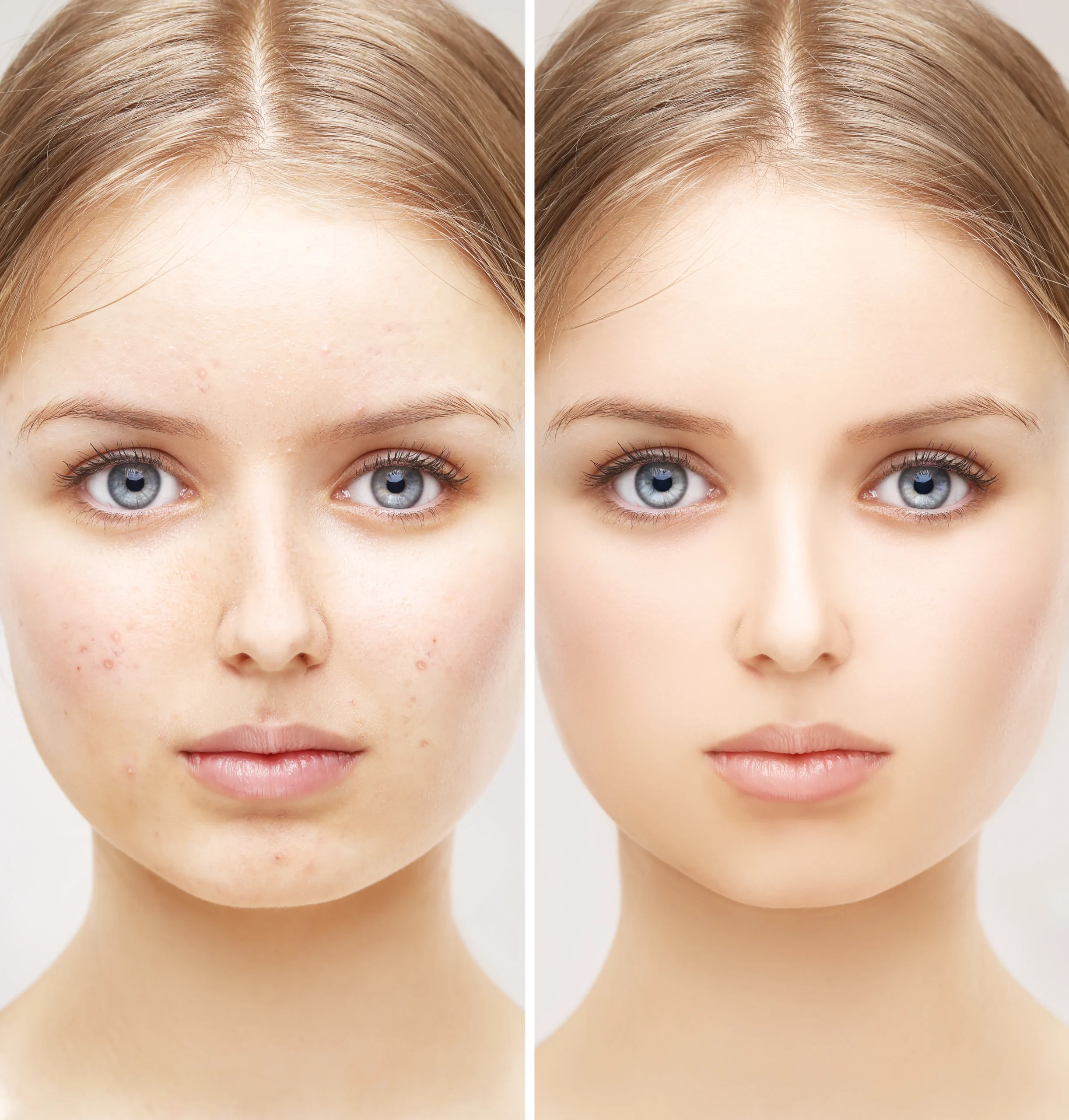 : Micro-needling device used during BB Glow procedure in Islamabad